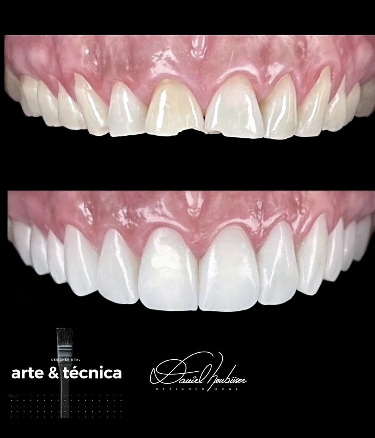 Antes e depois — lentes de contato dental