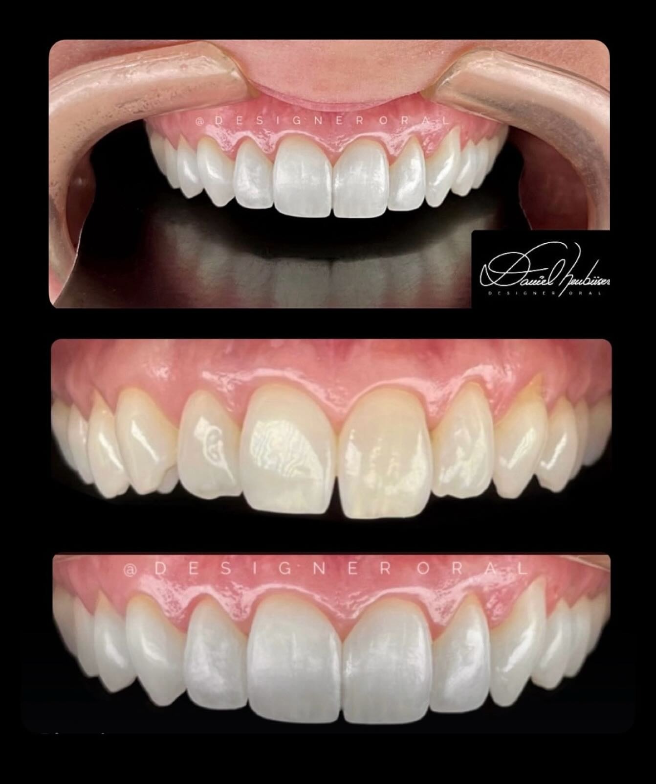 Antes e depois — sorriso natural com harmonização