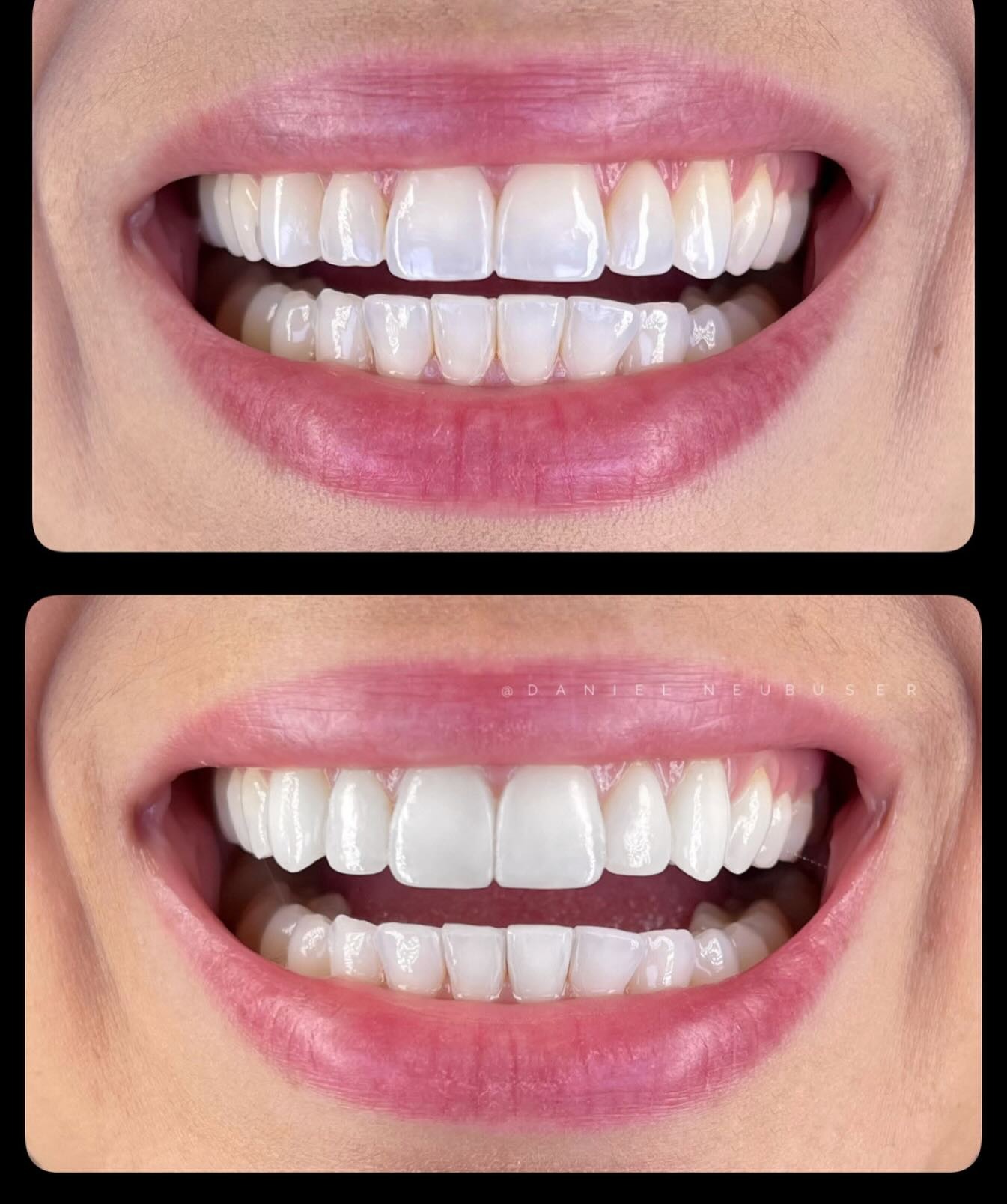 Antes e depois — clareamento e naturalidade