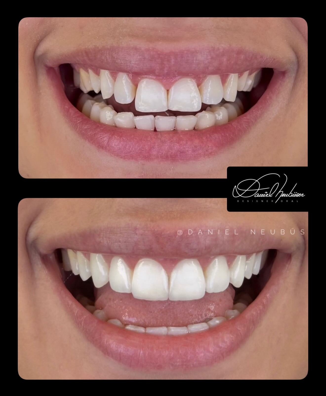 Antes e depois — fechamento de diastema